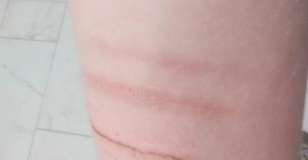 UMORNI STE, RANE VAM SPORO ZARASTAJU? Organizam vas jasno upozorava, evo ŠTA JE U PITANJU