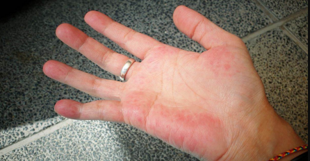 KAD PRITISNETE DLANOVE, KOŽA POBLIJEDI I FLEKE NESTANU? Ako ste ovaj simptom primijetili na rukama, EVO ŠTA JE U PITANJU