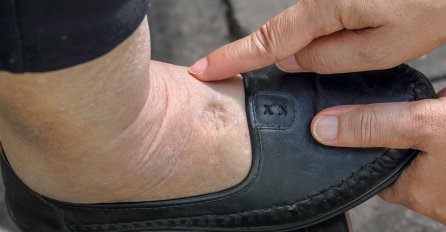 EVO KAKO DA IZBACITE VIŠAK VODE IZ TIJELA: Noge vam više neće biti natečene, evo šta trebate uraditi