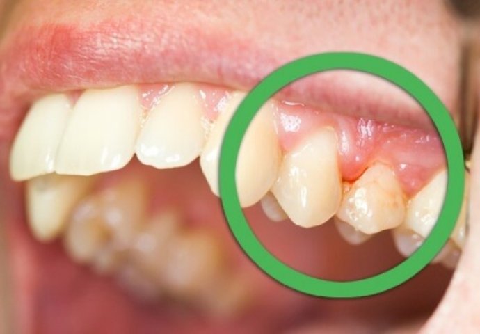 DA LI VAM JE UPALJENO I BOLNO ZUBNO MESO? NE IGRAJTE SE: Evo šta trebate uraditi