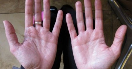 OVO SIGURNO NISTE ZNALI: Evo šta zaista znači kada vas zasvrbi dlan