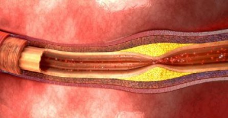 OVAKO IZGLEDAJU SIMPTOMI ZAČEPLJENIH ARTERIJA: Samo ovako možete problem uočiti na vrijeme