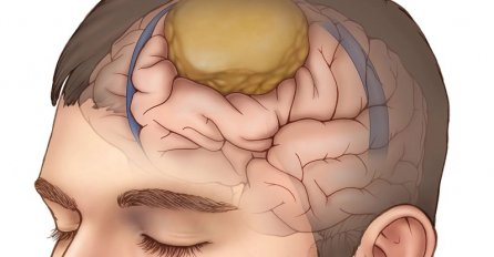 TUMOR NA MOZGU IMA 8 SIMPTOMA: Pacijenti ne primijete dok ne dođe do kritične tačke - dobro obratite pažnju