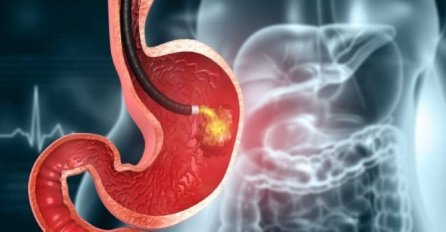 OVO JE  NAJBOLJI PRIRODNI LIJEK PROTIV GASTRITISA: Očistite želudac od toksina, spriječite rak želuca