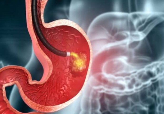 OVO JE  NAJBOLJI PRIRODNI LIJEK PROTIV GASTRITISA: Očistite želudac od toksina, spriječite rak želuca