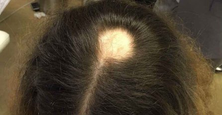 OVO JE 1. ZNAK DA ĆETE OĆELAVITI: Ako primijetite da se ovo dešava s kosom, VIJESTI SU LOŠE