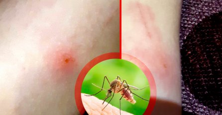 DOMAĆI TRIKOVI NAŠIH BAKA: Kad vas ujede komarac uradite ovo, nijednom se nećete POČEŠATI!