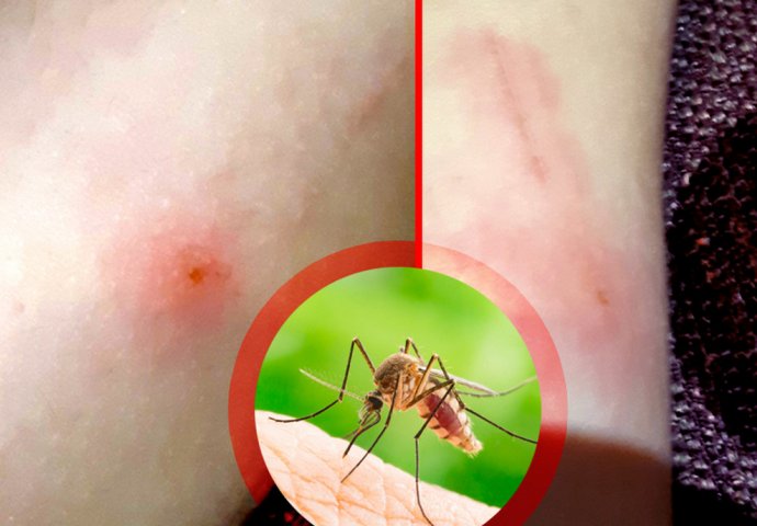 DOMAĆI TRIKOVI NAŠIH BAKA: Kad vas ujede komarac uradite ovo, nijednom se nećete POČEŠATI!