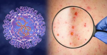 Država EU kupuje vakcinu protiv majmunskih boginja