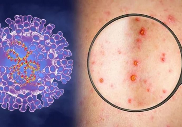 Država EU kupuje vakcinu protiv majmunskih boginja