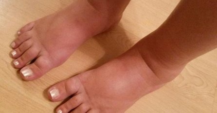 VIŠAK VODE IZ TIJELA ĆE NESTATI, SAMO JEDITE OVE 4 NAMIRNICE: Imate ih svi u kući, a super su i za mršanje