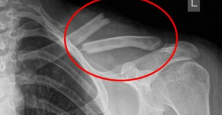 PRVI SIMPTOM KARCINOMA KOSTIJU JE BOL U OVOM DIJELU TIJELA: Morate ga primijetiti na vrijeme