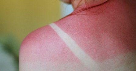Zaboravite jogurt: Ako izgorite na suncu, ovo će vas spasiti, tvrde dermatolozi