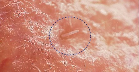 Ovi kožni paraziti polako se stapaju s našim licem