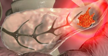 RAK PANKREASA IMA 6 SIMPTOMA: Raste dugo i tiho, a onda se javlja ovaj znak