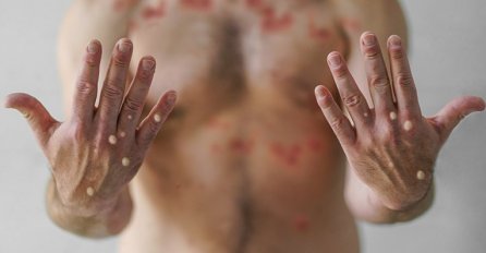 U BiH potvrđen prvi slučaj zaraze majmunskim boginjama