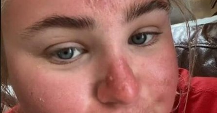 "BILA SAM SAMO 1h NA SUNCU, POGLEDAJTE NA ŠTA LIČIM": Kakve posljedice mogu da budu ako ne koristite zaštitni faktor 