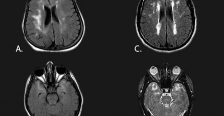 Svjetski stručnjak za Alzheimer objasnio uzrok demencije: Evo što je “biološko smeće”