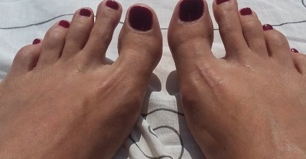VISOK HOLESTEROL MOŽE DA SE VIDI NA NOGAMA: Kardiolog upozorio - Ako primijetite ovo na prstima u OPASNOSTI STE