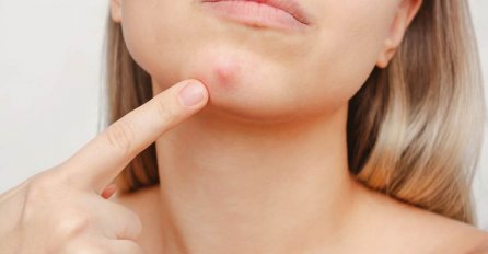 DIO LICA NA KOJEM NE SMIJETE CIJEDITI BUBULJICE: Može imati strašne posljedice