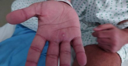 Nova studija otkrila još dva simptoma koja mogu ukazivati na majmunske boginje