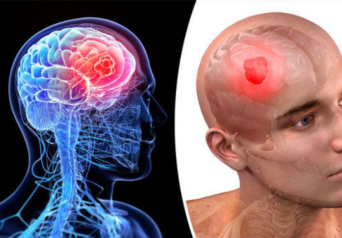 SIMPTOM TUMORA NA MOZGU KOJI SE ČESTO ZANEMARUJE: Svi se boje glavobolje, a nešto drugo je pravi alarm