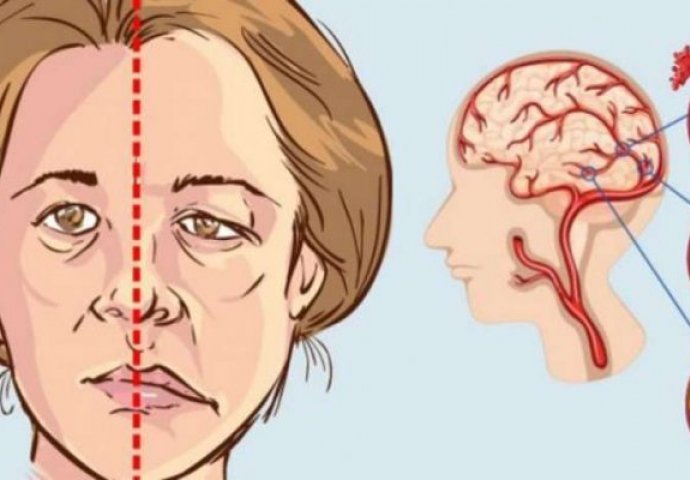 ŠEST NEPRIMJETNIH SIMPTOMA RAKA MOZGA: Ako uočite neku od ovih promjena, odmah se javite ljekaru