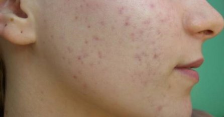 DA LI IMATE POTKOŽNE BUBULJICE NA LICU? NI SLUČAJNO IH NE ISTISKAJTE? Evo zašto su se pojavile i kako da ih uklonite