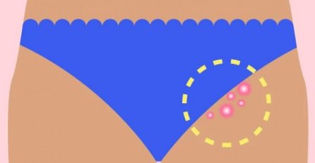 ŽENE, OVO NIJE OD DEPILACIJE: Evo zašto nastaju BUBULJICE NA PREPONAMA - odmah reagujte