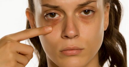 IMATE PODOČNJAKE? Ublažite ih sa samo dva sastojka iz kuhinje, DJELJUJE ODMAH