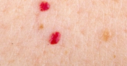 IMATE CRVENE TAČKICE NA TIJELU: Mnogi misle da su ispucali kapilari, a o OVOME JE RIJEČ