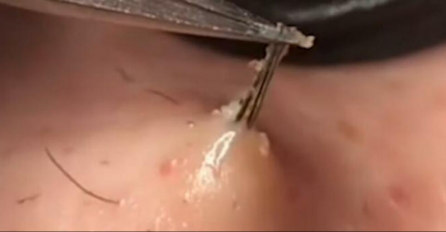 4 MJESECA JE BIO U KOMI, OPERACIJA MU JE TRAJALA ŠEST SATI: Urasla DLAKA mu napravila PAKAO OD ŽIVOTA, a evo i kako 