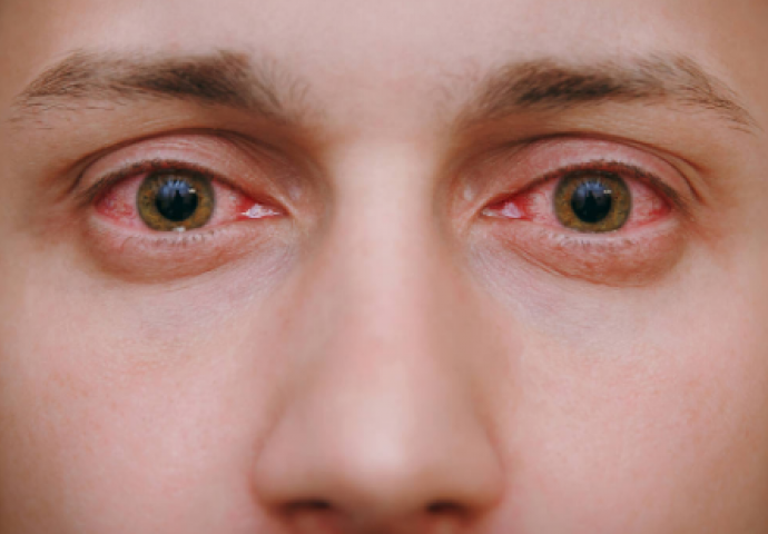 Spas za oči - Liječenje konjuktivitisa biljnim putem