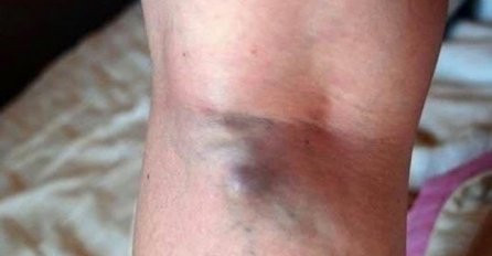 NAMIRNICE KOJE POVEĆAVAJU RIZIK OD TROMBOZE, JEDNA POSEBNO: Jedemo ih svakoga dana, a štete arterijama