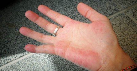 KAD PRITISNETE DLANOVE, KOŽA POBLIJEDI I FLEKE NESTANU? Ako ste ovaj simptom primijetili na rukama, hitno se obratite ljekaru