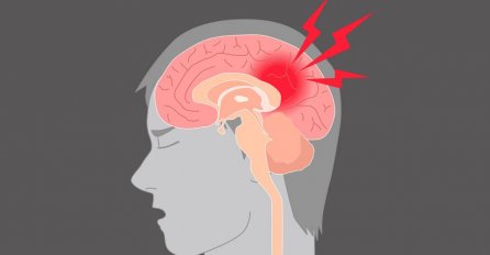 Jedan simptom MOŽDANOG UDARA je važan i može vam spasiti život