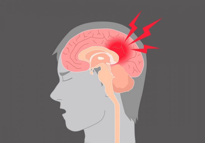 Jedan simptom MOŽDANOG UDARA je važan i može vam spasiti život