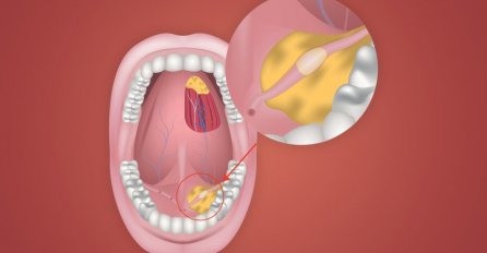 2 SIMPTOMA NA LICU OTKRIVAJU KAMEN U PLJUVAČNOJ ŽLIJEZDI: Obratite pažnju ako se ovo pojavi