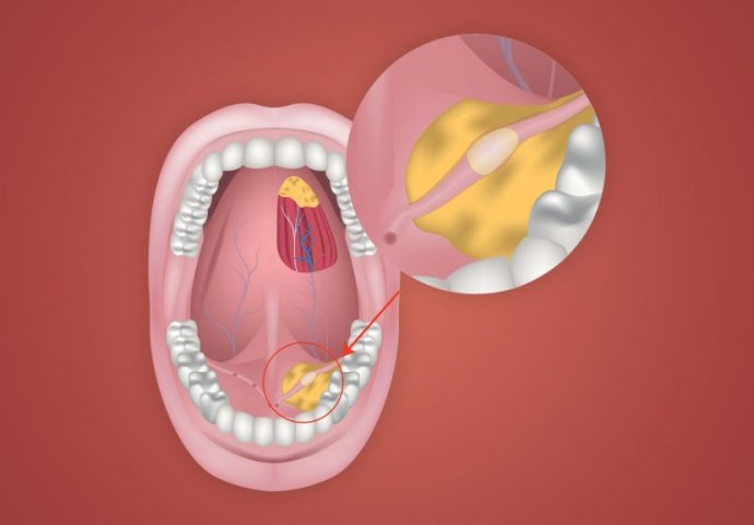 2 SIMPTOMA NA LICU OTKRIVAJU KAMEN U PLJUVAČNOJ ŽLIJEZDI: Obratite pažnju ako se ovo pojavi