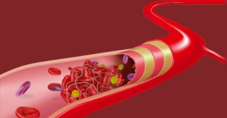 Nutricionista upozorava na tri namirnice koje začepljuju arterije