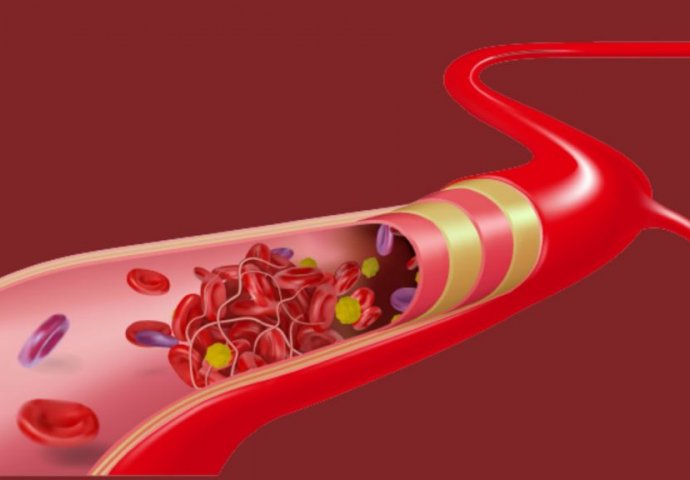 Nutricionista upozorava na tri namirnice koje začepljuju arterije