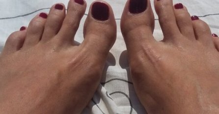 VISOK HOLESTEROL MOŽE SE VIDJETI NA NOGAMA: Kardiolog upozorio – Ako primijetite ovo na prstima u OPASNOSTI STE