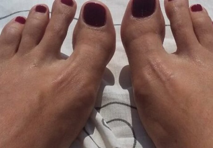 VISOK HOLESTEROL MOŽE SE VIDJETI NA NOGAMA: Kardiolog upozorio – Ako primijetite ovo na prstima u OPASNOSTI STE