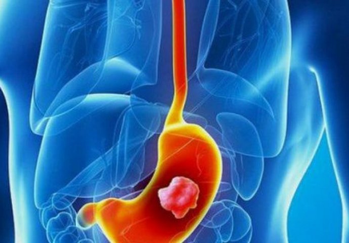 OVO SU ZNAKOVI DA SE U STOMAKU RAZVIJA OPASAN TUMOR: Evo koji simptomi ukazuju na RAK ŽELUCA