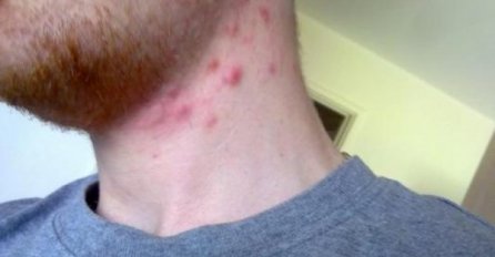 DA LI IMATE BUBULJICE NA VRATU? Evo na šta vas organizam upozorava, NE ZANEMARUJTE!