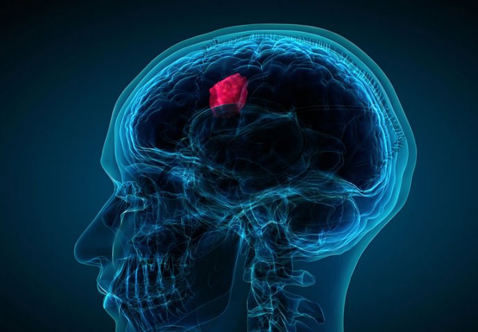 TUMOR NA MOZGU: 7 simptoma koje je vrlo važno prepoznati na vrijeme