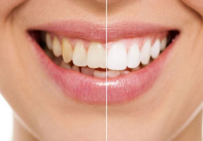 KAKO IZBIJELITI ZUBE ZA 5 MINUTA: Iskoristite ovaj proizvod koji imate kod kuće i vaši zubi će se bukvalno cakliti
