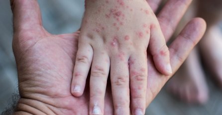 U Srbiji proglašena epidemija morbila, zaraženi uglavnom nevakcinisani