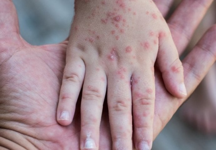 U Srbiji proglašena epidemija morbila, zaraženi uglavnom nevakcinisani