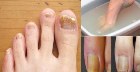GLJIVICE NESTAJU PREKO NOĆI: Potopite noge u jednu od ovih mješavina i zauvijek se riješite gljivičnih infekcija na vašim stopalima!